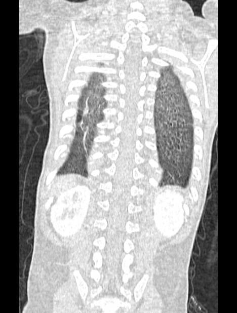 Asplenia syndrome (Radiopaedia 73083-83792 Coronal lung window 118).jpg