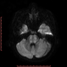 Astroblastoma (Radiopaedia 74287-85162 Axial DWI 23).jpg