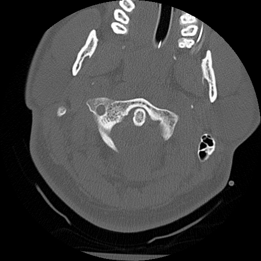 File:Atlanto-occipital dissociation injury (Radiopaedia 29274-29698 Axial bone window 14).png