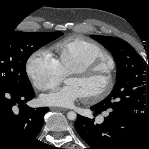 File:Atrial septal defect (upper sinus venosus type) with partial anomalous pulmonary venous return into superior vena cava (Radiopaedia 73228-83961 A 143).jpg
