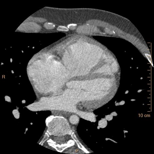 Atrial septal defect (upper sinus venosus type) with partial anomalous pulmonary venous return into superior vena cava (Radiopaedia 73228-83961 A 144).jpg