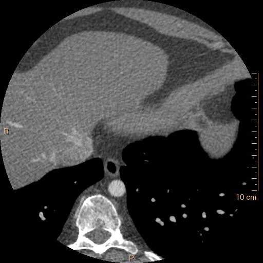 Atrial septal defect (upper sinus venosus type) with partial anomalous pulmonary venous return into superior vena cava (Radiopaedia 73228-83961 A 252).jpg
