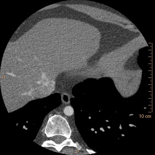 Atrial septal defect (upper sinus venosus type) with partial anomalous pulmonary venous return into superior vena cava (Radiopaedia 73228-83961 A 254).jpg