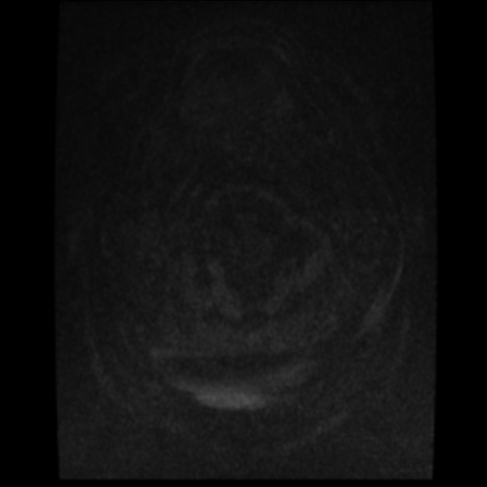 Atypical meningioma (Radiopaedia 45535-49629 Axial T1 C+ 68).jpg