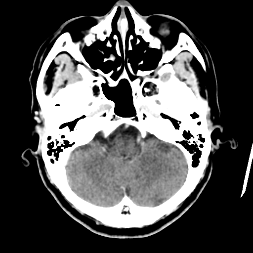 Atypical meningioma (WHO grade II) with osseous invasion (Radiopaedia 53654-59715 Axial C+ delayed 13).png