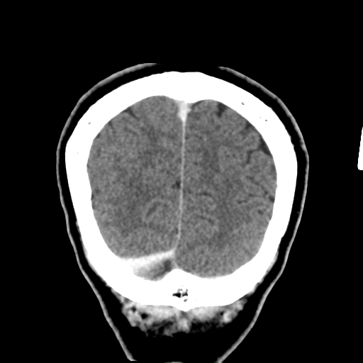Atypical meningioma (WHO grade II) with osseous invasion (Radiopaedia 53654-59715 Coronal C+ delayed 52).png