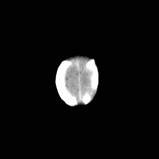 File:Atypical teratoid rhabdoid tumor (prenatal US and neonatal MRI) (Radiopaedia 59091-66387 Axial non-contrast 36).jpg