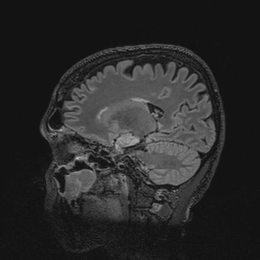 Autoimmune limbic encephalitis (Radiopaedia 30363-31005 Sagittal FLAIR 97).jpg