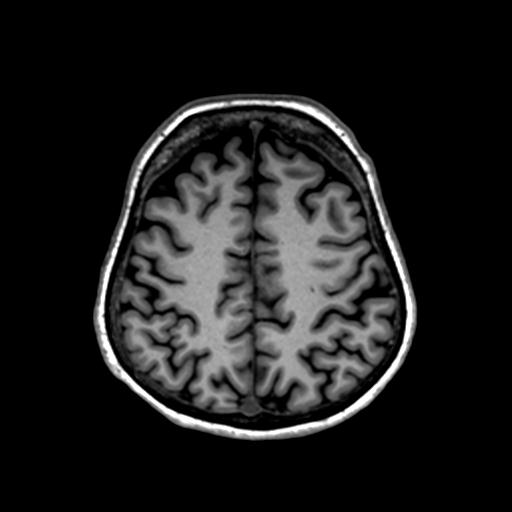 Autoimmune limbic encephalitis (Radiopaedia 30363-31005 T1 Axial 1mm 113).jpg