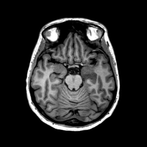 Autoimmune limbic encephalitis (Radiopaedia 30363-31005 T1 Axial 1mm 59).jpg