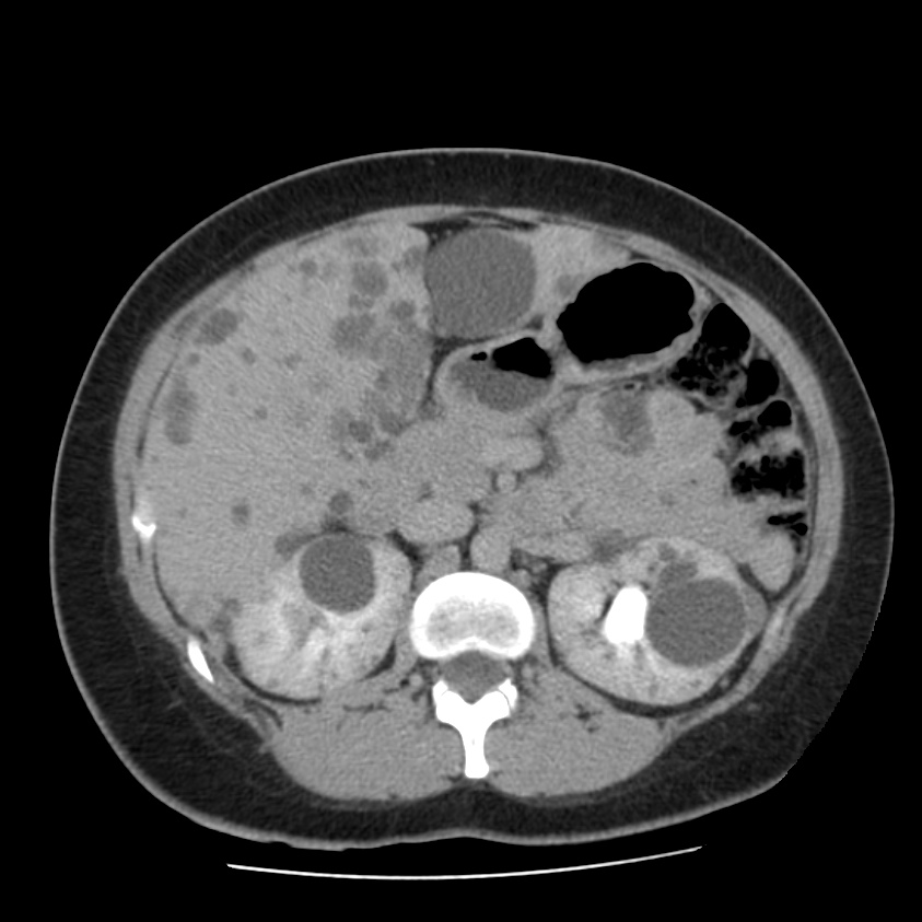Autosomal dominant polycystic kidney disease (Radiopaedia 23061-23093 C+ delayed 25).jpg