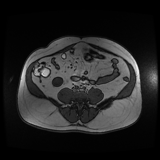 Autosomal dominant polycystic kidney disease (Radiopaedia 50259-55611 Axial 2D Dual Echo 71).jpg