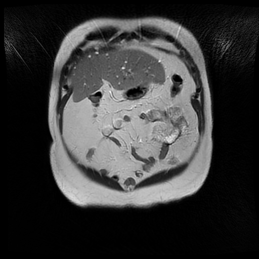 File:Autosomal dominant polycystic kidney disease (Radiopaedia 50259-55611 Coronal T2 7).jpg