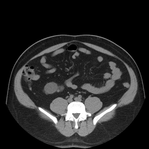 File:Autosomal dominant polycystic kidney disease (Radiopaedia 50259-55612 Axial non-contrast 56).jpg