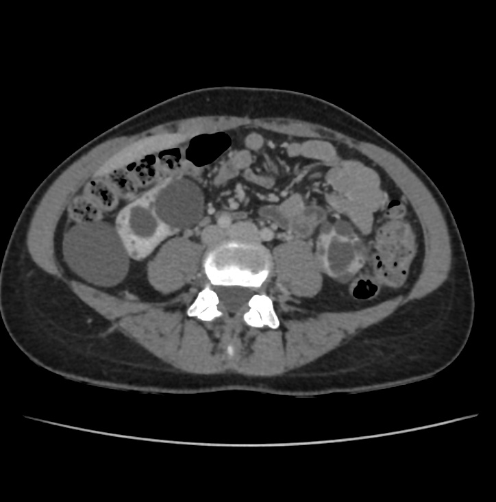 Autosomal dominant polycystic kidney disease - early onset (Radiopaedia 40734-43387 A 53).jpg