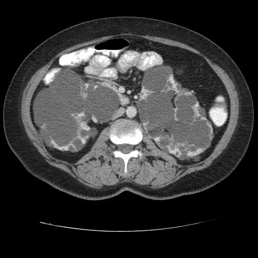 Autosomal dominant polycystic kidney disease with hepatic involvement (Radiopaedia 32693-33662 B 38).jpg