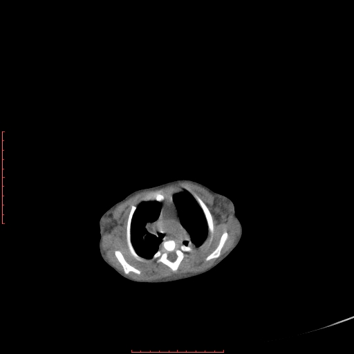 Autosomal recessive polycystic kidney disease associated with Caroli disease (Radiopaedia 61932-69984 B 27).jpg