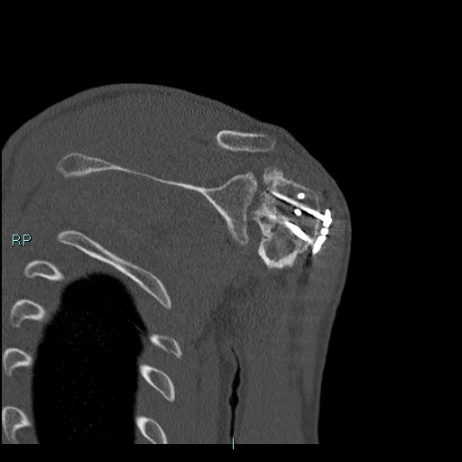 Avascular necrosis after fracture dislocations of the proximal humerus (Radiopaedia 88078-104655 Coronal bone window 87).jpg