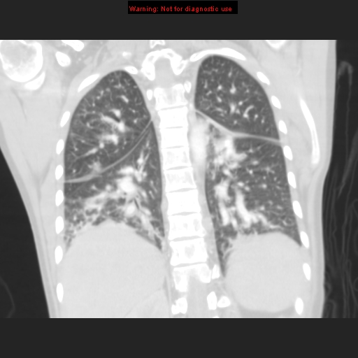 Avascular necrosis in sickle cell disease (Radiopaedia 17448-17152 B 90).jpg