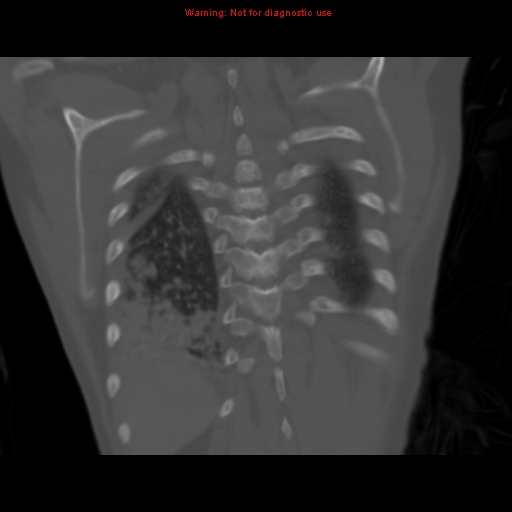 File:Avascular necrosis in sickle cell disease (Radiopaedia 17448-17152 Coronal bone window 107).jpg