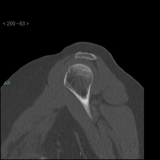 Avascular necrosis of the shoulder - Cruess stage I (Radiopaedia 77674-89887 Sagittal bone window 62).jpg