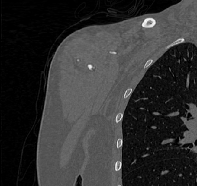 Avulsion fracture - greater tuberosity of humerus (Radiopaedia 71216-81514 Coronal bone window 2).jpg