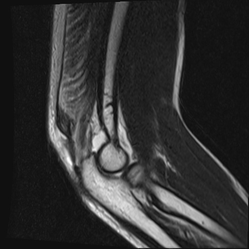 File:Avulsion of the triceps tendon (Radiopaedia 42919-46154 Sagittal T2 2).jpg
