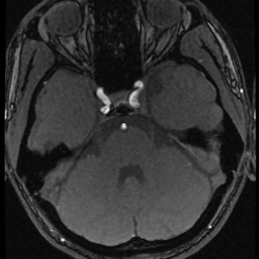 Azygos anterior cerebral artery (Radiopaedia 17059-16756 Axial MRA 60).jpg