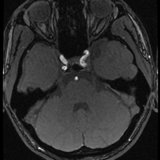 Azygos anterior cerebral artery (Radiopaedia 17059-16756 Axial MRA 61).jpg