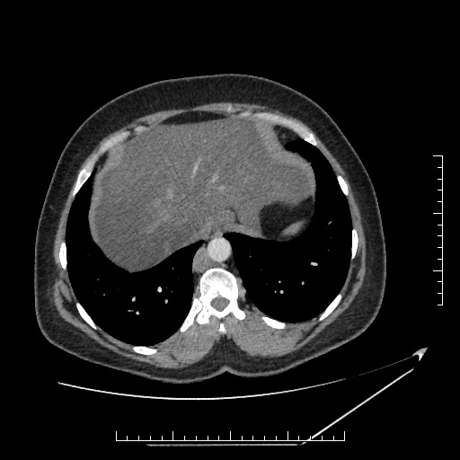 File:Azygos continuation of the IVC (Radiopaedia 40416-42965 A 9).jpg