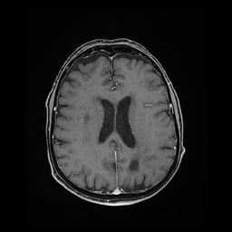 Balo concentric sclerosis (Radiopaedia 53875-59982 Axial LAVA C+ 166).jpg