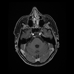 Balo concentric sclerosis (Radiopaedia 53875-59982 Axial LAVA C+ 78).jpg