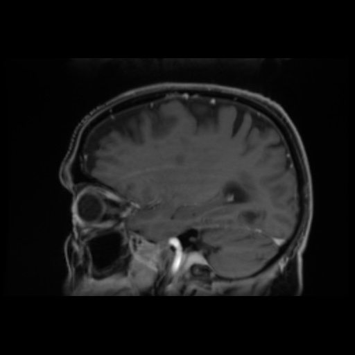 File:Balo concentric sclerosis (Radiopaedia 53875-59982 Sagittal LAVA C+ 21).jpg