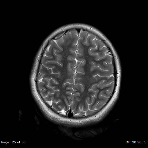 File:Balo concentric sclerosis (Radiopaedia 61637-69636 Axial T2 25).jpg