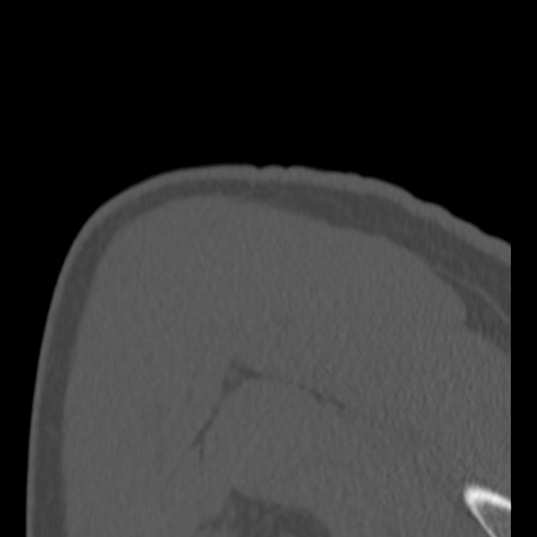 Bankart lesion (Radiopaedia 57256-64185 Coronal bone window 45).jpg