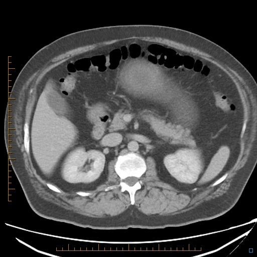 File:Bariatric balloon causing gastric outlet obstruction (Radiopaedia 54449-60672 A 16).jpg