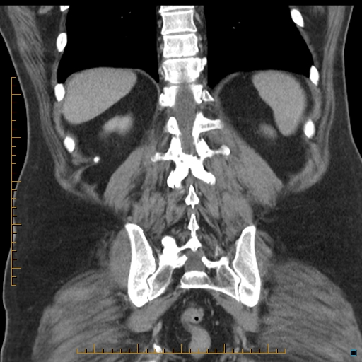 File:Bariatric balloon causing gastric outlet obstruction (Radiopaedia 54449-60672 B 47).jpg