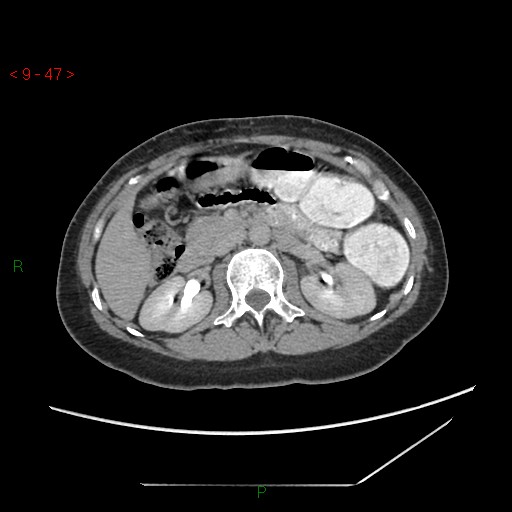 File:Bartholin gland cyst (Radiopaedia 54904-61181 Axial C+ delayed 12).jpg