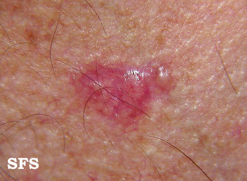 Basal Cell Carcinoma (Dermatology Atlas 29).jpg