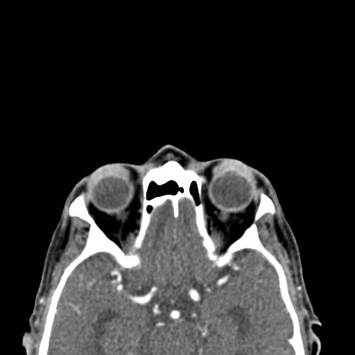File:Basal cell carcinoma (periocular with orbital invasion) (Radiopaedia 30974-31672 Axial Postcontrast 22).jpg