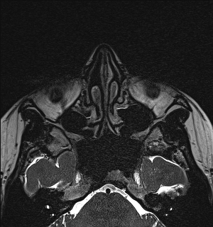Basal cell carcinoma - nasal region (Radiopaedia 70292-80365 Axial Gradient Echo 49).jpg