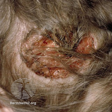 Basal cell carcinoma affecting the face (DermNet NZ lesions-bcc-face-0636).jpg