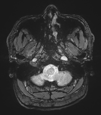 File:Basal ganglia hemorrhage - hypertensive (Radiopaedia 42227-45303 Axial SWI magnitude 4).png