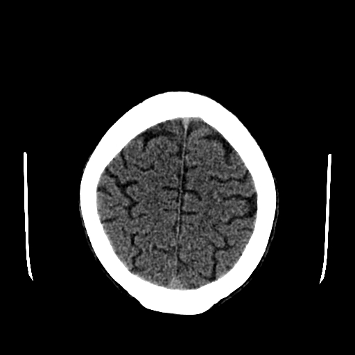 File:Basilar artery perforator aneurysm (Radiopaedia 82455-96597 Axial non-contrast 28).jpg