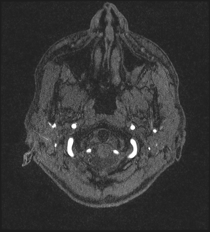 Basilar artery perforator aneurysm (Radiopaedia 82455-97733 Axial MRA 7).jpg