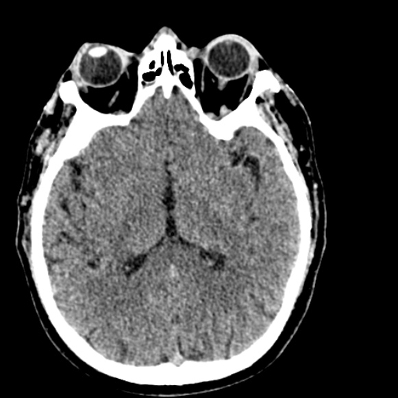 Basilar artery thrombosis (Radiopaedia 53351-59333 Axial non-contrast 65).jpg