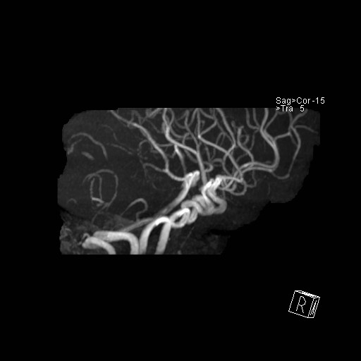 Basilar tip aneurysm (Radiopaedia 26504-26632 D 38).jpg