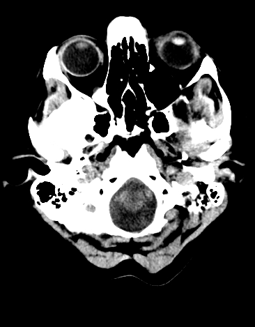 File:Basilar tip aneurysm with coiling (Radiopaedia 53912-60033 Axial 25).jpg