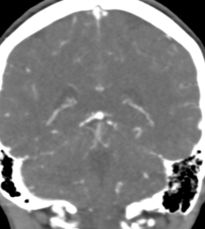 Basilar tip aneurysm with coiling (Radiopaedia 53912-60086 B 105).jpg