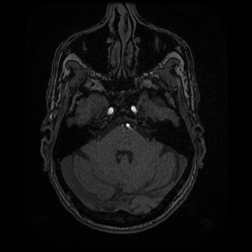 Basilar top and left middle cerebral artery aneurysm (Radiopaedia 61965-70031 Axial MRA 35).jpg